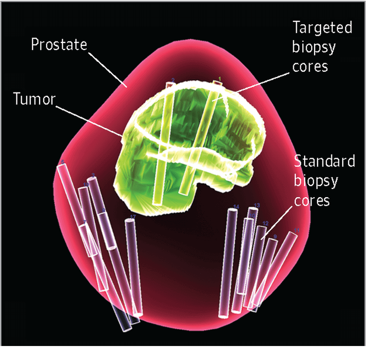 biopsy needles mri technology