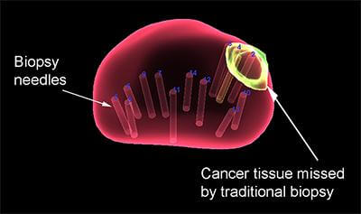 biopsy needles mri technology 2