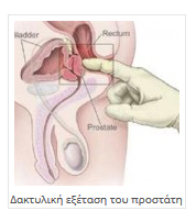  Δακτυλική εξέταση του προστάτη