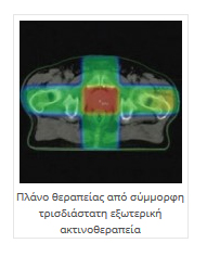  Ακτινοθεραπευτική αντιμετώπιση