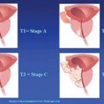 Καρκίνος Προστάτη
