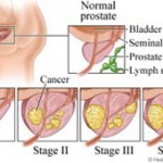 Καρκίνος Προστάτη
