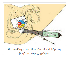 Πλεονεκτήματα CyberKnife®