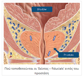 Πλεονεκτήματα CyberKnife®