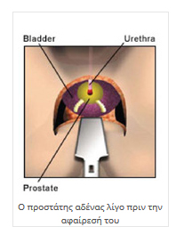 προστάτης αδένας πριν την αφαίρεσή του