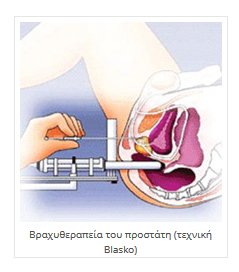 Βραχυθεραπεία του προστάτη