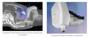 Ρομποτική Στερεοτακτική Ακτινοχειρουργική με CyberKnife